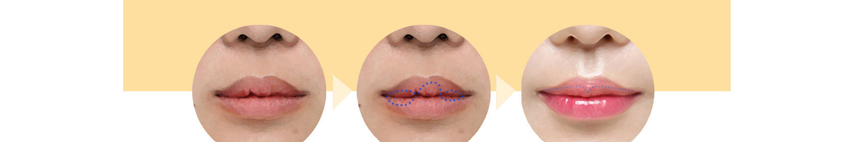 Before and after lip mucosa asymmetry correction
