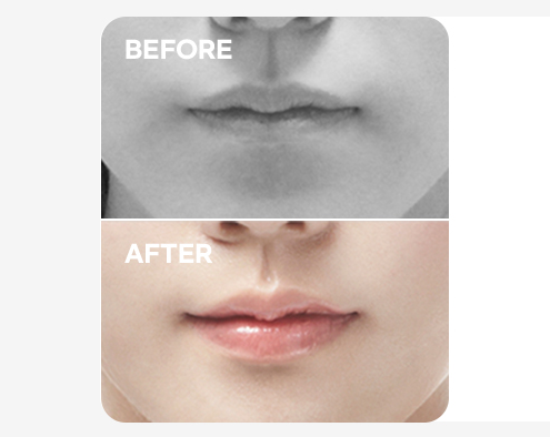 For Thin Lips Before & After