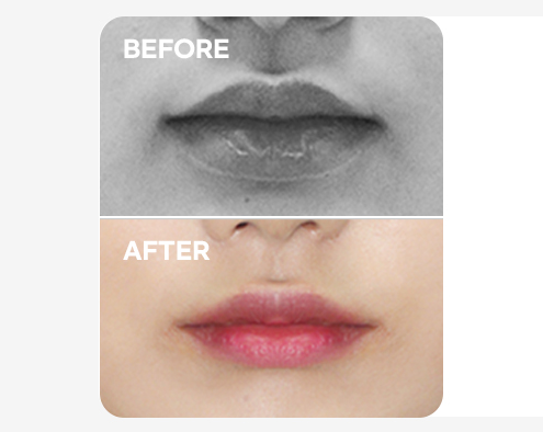 For Thick Lips Before & After