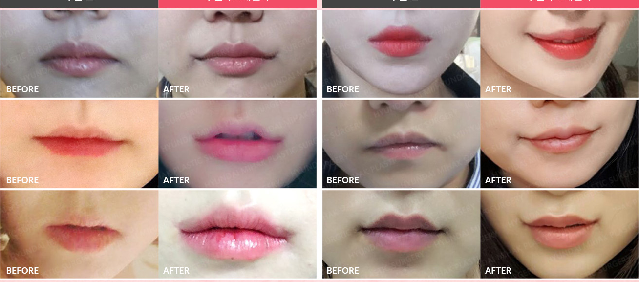 Before-and-after case of mouth corner revision surgery