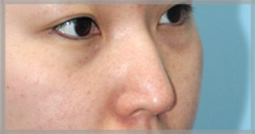 Arrowhead nose surgery before — side-view photo of the nose (BEFORE)