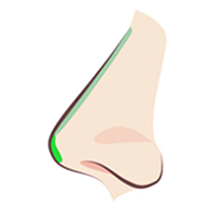 TYPE 01 after procedure — diagram of a smoothly corrected nose