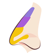 TYPE 01 before procedure — diagram of a nose with a low bridge and hump