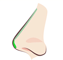 TYPE 02 after procedure — diagram of a nose corrected by lifting the cartilage