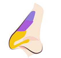 TYPE 02 before procedure — diagram of a nose with downward-drooping cartilage