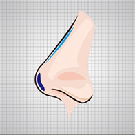 After severe hump nose correction