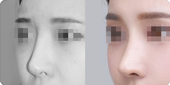 Side-view before-and-after comparison 2 of no-prosthesis rhinoplasty (BEFORE / AFTER 3MONTH)