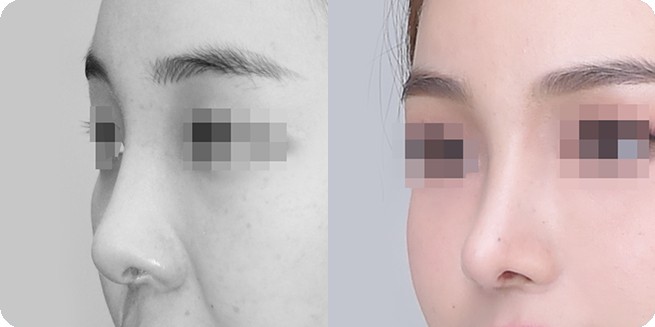 Side-view before-and-after comparison 3 of no-prosthesis rhinoplasty (BEFORE / AFTER 3MONTH)