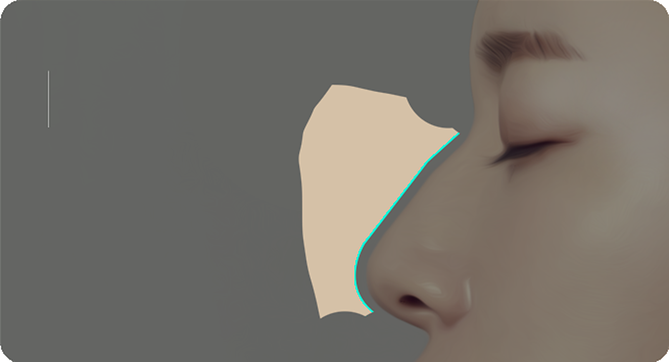 Side view of a nose with appropriate radix height and a high nasal tip