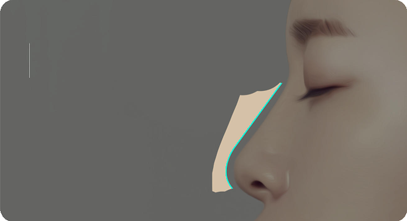 Side view of a nose with appropriate radix height and a low nasal tip
