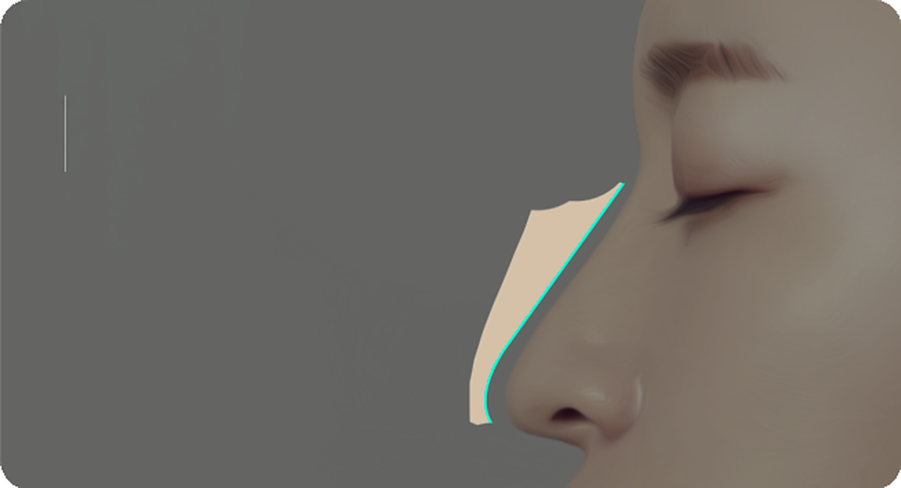 Side view of a nose with appropriate radix height and a drooping nasal tip
