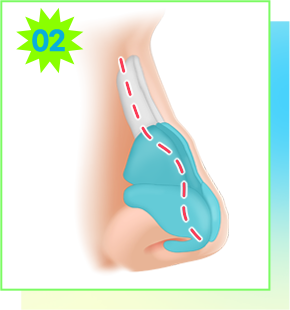 Surgical diagram for deviation of the nasal dorsum and septal cartilage