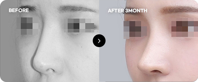 Before and after high nasal bridge line revision 1