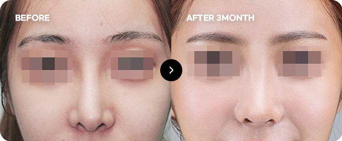 Before and after nasal tip line revision 4