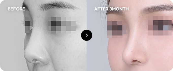 Before and after high nasal bridge line revision 2