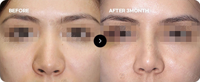 Before and after revision surgery for contracted nose 2