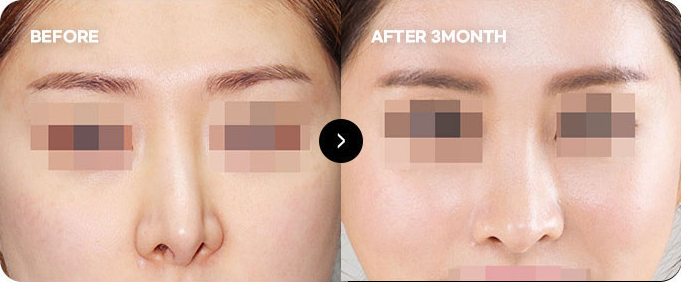 Before and after revision for surgically deviated nose & skin adhesion 1