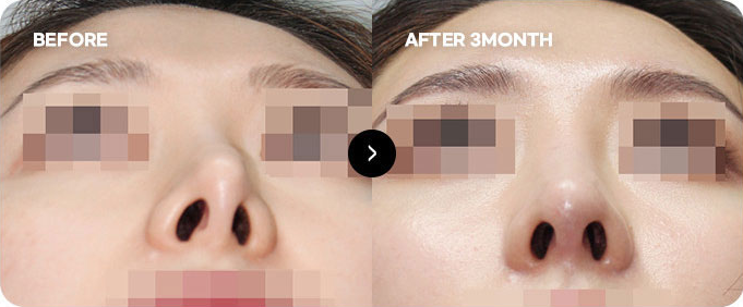Before and after revision for surgically deviated nose & skin adhesion 2