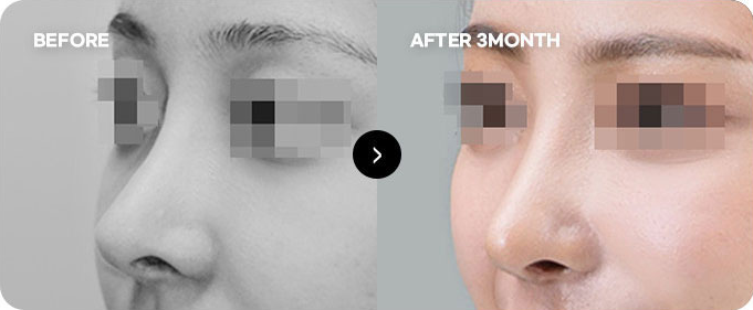 Before and after nasal tip line revision 1